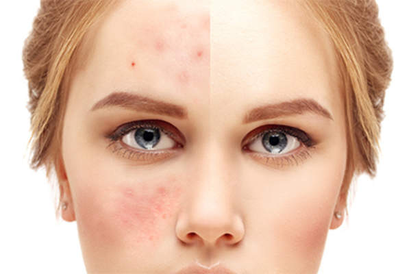 Young woman with skin problems, clear skin.