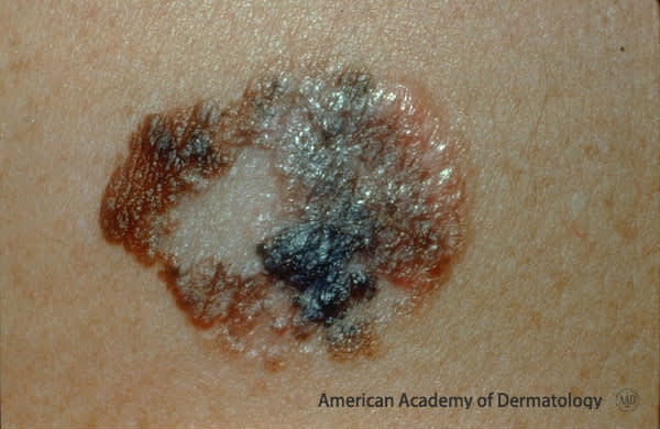 Malignant melanoma 1829 copy