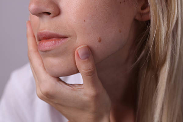 Woman with a mole on her face.