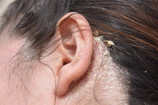 Woman with very dry skin behind her ear.