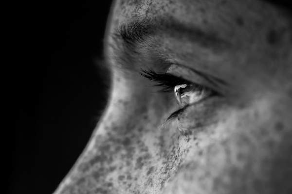 Close up of eyes surrounded by many freckles/sun spots