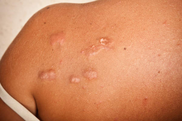 Keloids