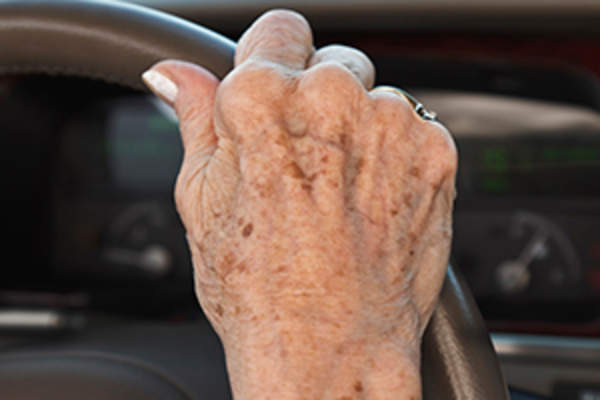 bruising on senior woman's hand