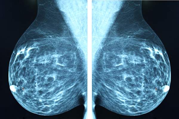 breast imaging image