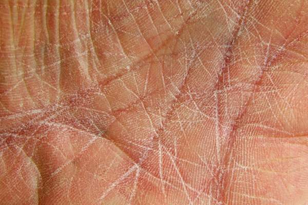Dried skin on palm of hand.