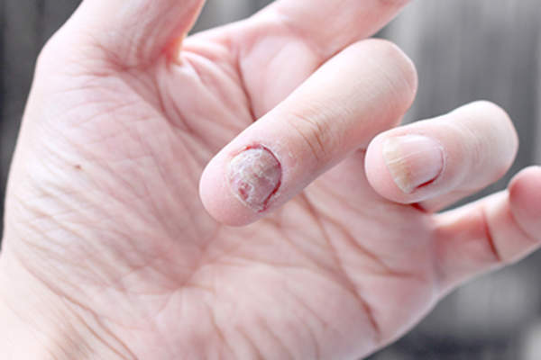 Psoriasis damaged nails.