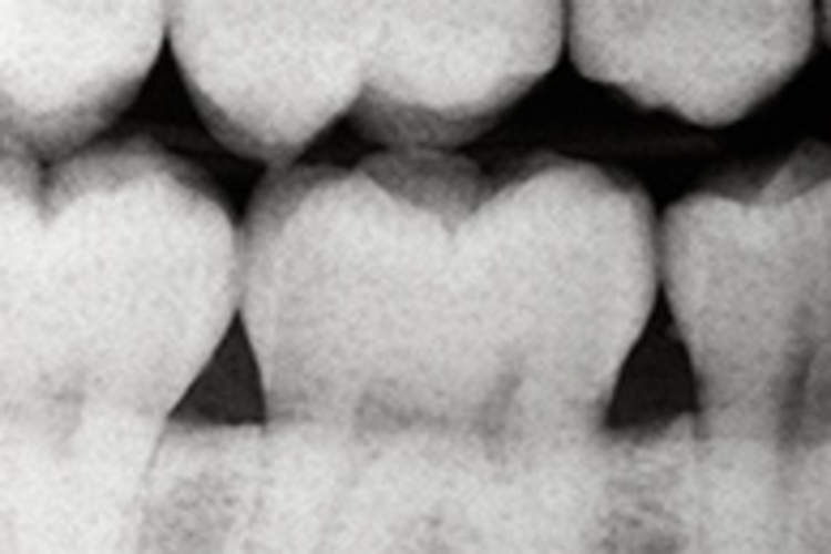 How Unhealthy Teeth Hurt Your Health