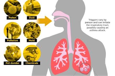 Anatomy of an Asthma Attack