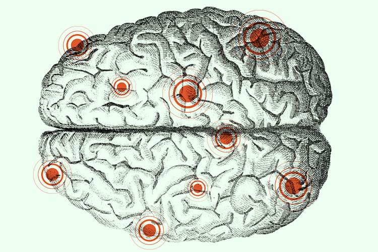 What is Epilepsy? (Infographic)