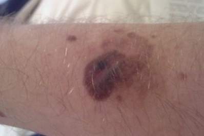 A melanoma on a body part.