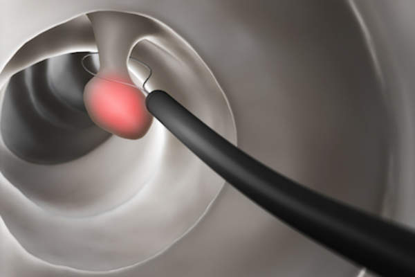 rendered image of polyp removal during colonoscopy.