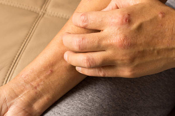 Scratching eczema.