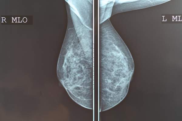 Mammography breast scan