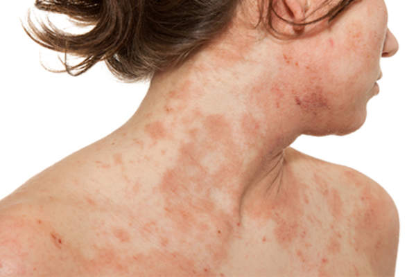 Young woman with severe dermatitis.