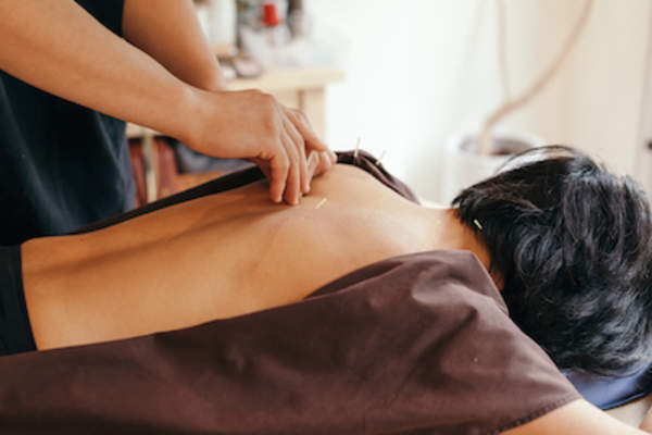 Woman undergoing acupuncture treatment.