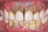 Photo of gum disease