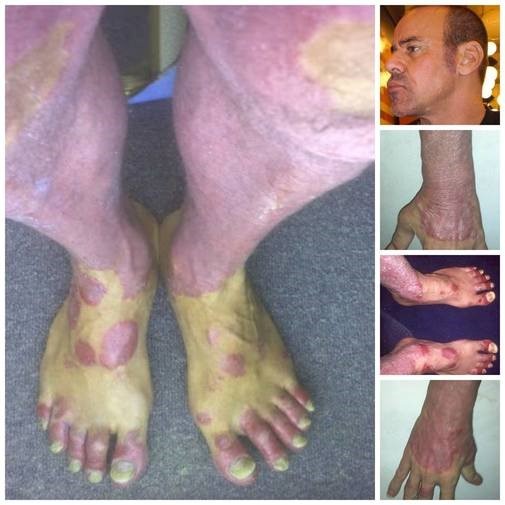 men defeating psoriasis