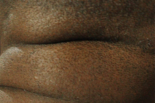Folds of skin.