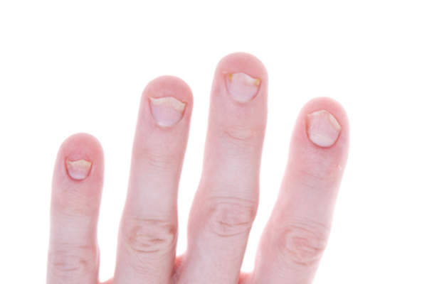 Psoriasis figernails.