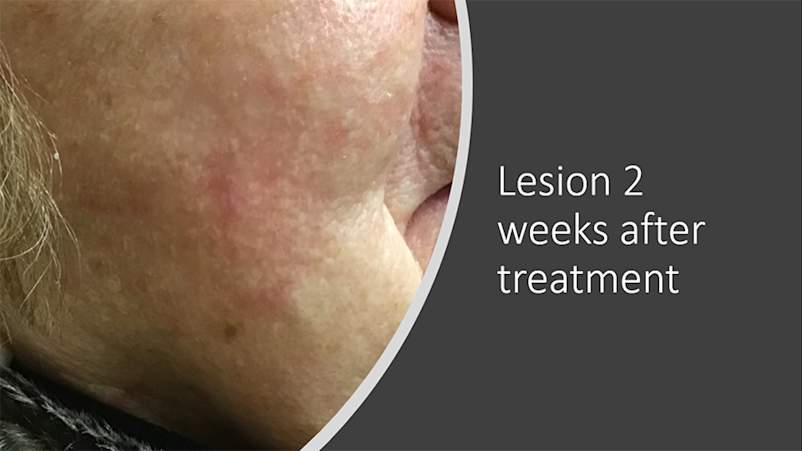 Lesion after treatment