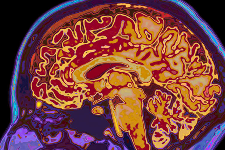 Brain MRI dementia.