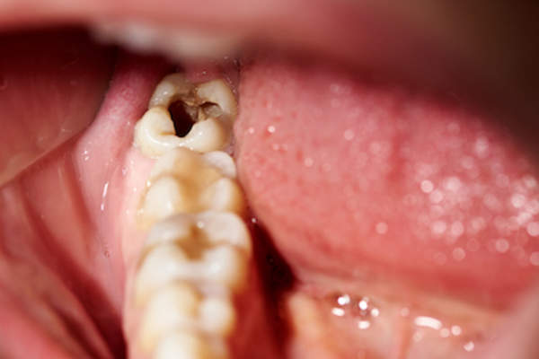 Close up of cavity in molar.
