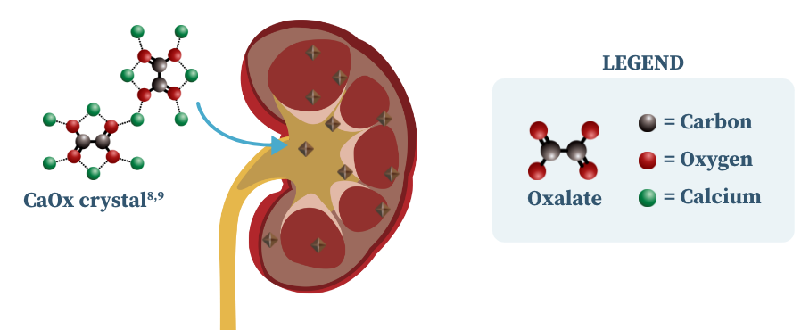 Graphic showing that calcium oxalate crystals combine to form kidney stones in people with primary hyperoxaluria. Graphic showing that calcium oxalate crystals combine to form kidney stones in people with primary hyperoxaluria.
