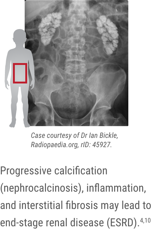 X-ray showing nephrocalcinosis in the kidneys. X-ray showing nephrocalcinosis in the kidneys.