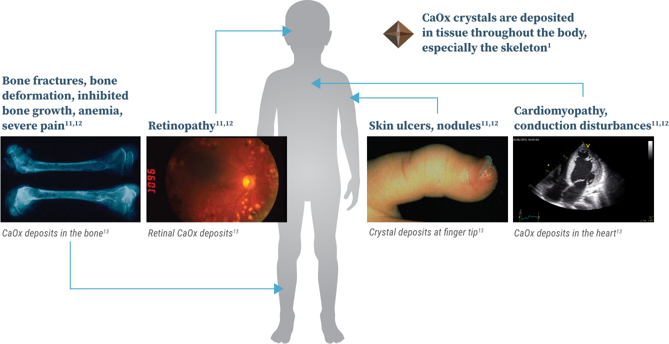 Graphic with images showing how systemic oxalosis can affect people with primary hyperoxaluria. Graphic with images showing how systemic oxalosis can affect people with primary hyperoxaluria.