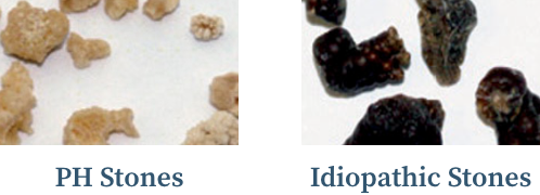 Graphic showing the burden of kidney stones in people with primary hyperoxaluria, and images of idiopathic and primary hyperoxaluria stones. Graphic showing the burden of kidney stones in people with primary hyperoxaluria, and images of idiopathic and primary hyperoxaluria stones.