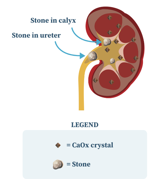 Graphic showing that calcium oxalate crystals combine to form kidney stones in people with primary hyperoxaluria. Kidney - Right Graphic showing that calcium oxalate crystals combine to form kidney stones in people with primary hyperoxaluria. Kidney - Right