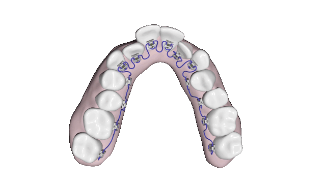 Breezy Braces