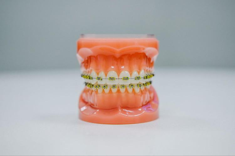 Plastic teeth mold with braces attached.