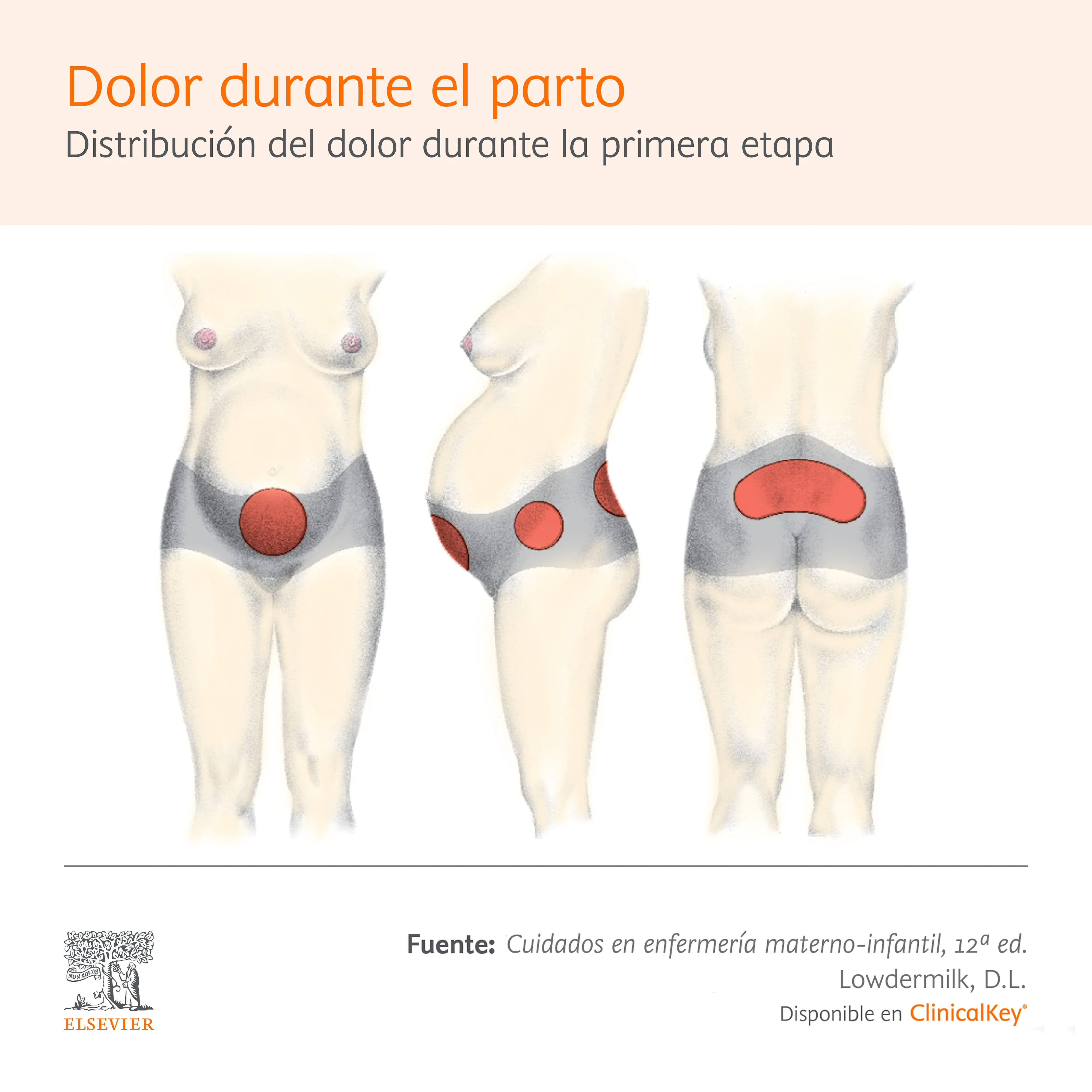 SLM Infografia Dolor parto 1