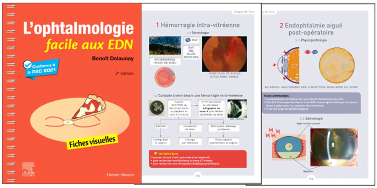 L'ophtalmologie aux EDN avec les fiches visuelles