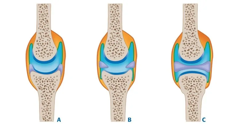 Figure 3.3: Surfaces articulaires fibrocartilagineuses