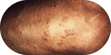 Poison Ivy, Oak, and Sumac Rashes: Symptoms and Treatments - Image 1 - Benadryl - en-US