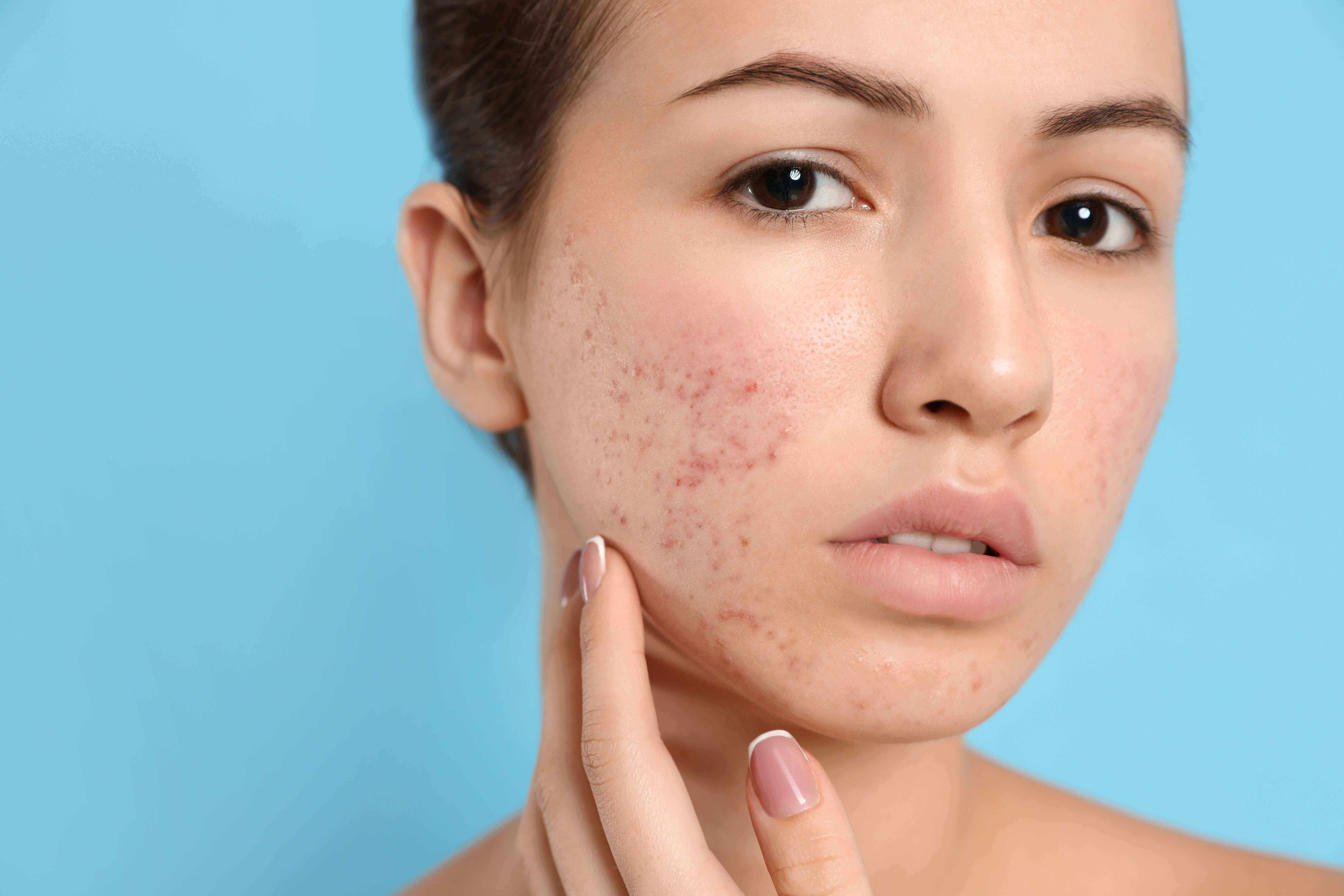 What Is Cystic Acne Treatment And Prevention Gopuff