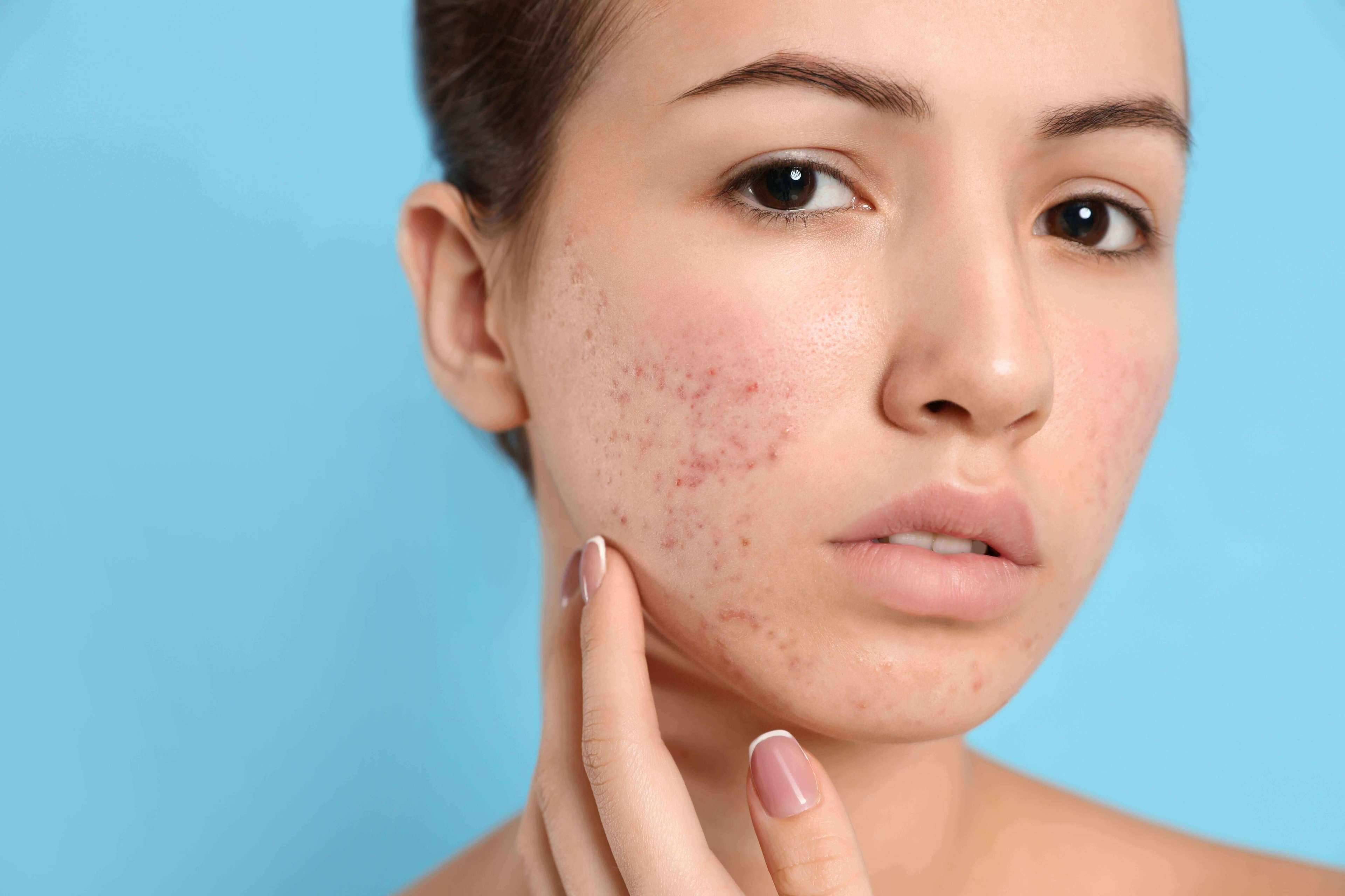 Teen girl with acne problem on light blue background