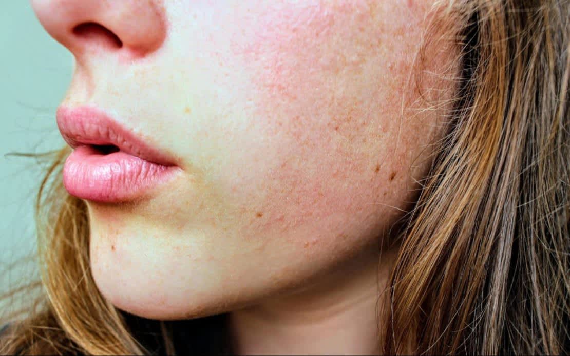 Close up of woman’s face with dry skin 