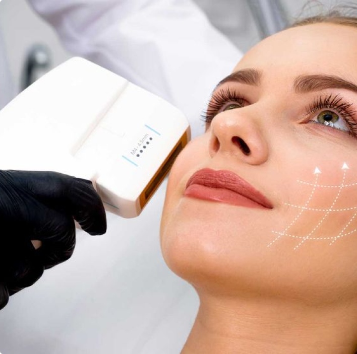 Ultraformer III (HIFU) Women receive a facial skin tightening treatment with an advanced cosmetic device, showing lifting and contouring effects on the cheek area.