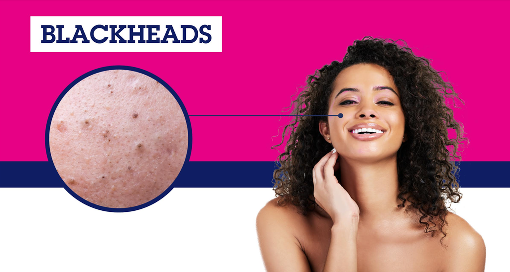 Causes of Blackheads on Cheeks fr-ca