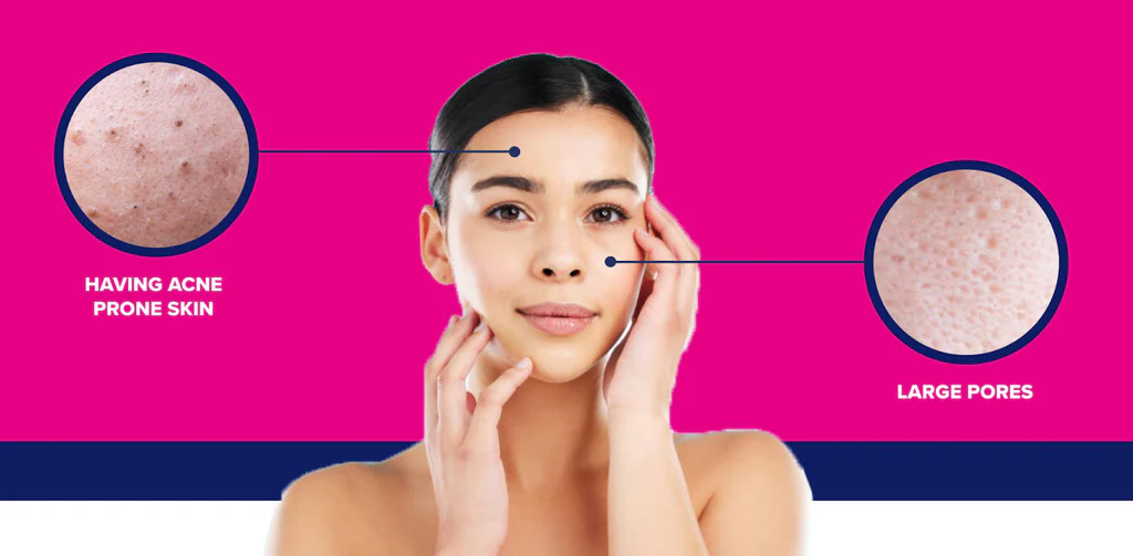 How to Get Rid of Oily Skin 1024x1024