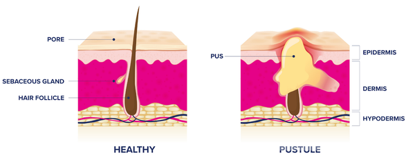 Signs of Clogged Pores 