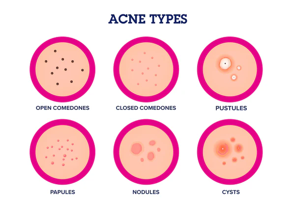Acne-Types 600x600