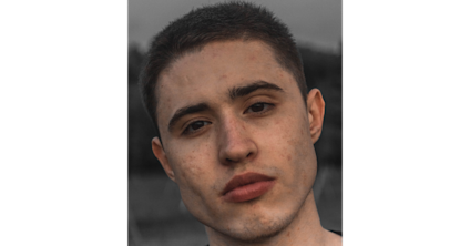 How To Get Rid of Acne