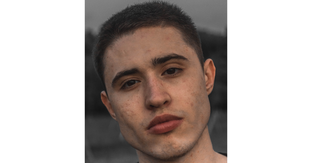 How To Get Rid of Acne