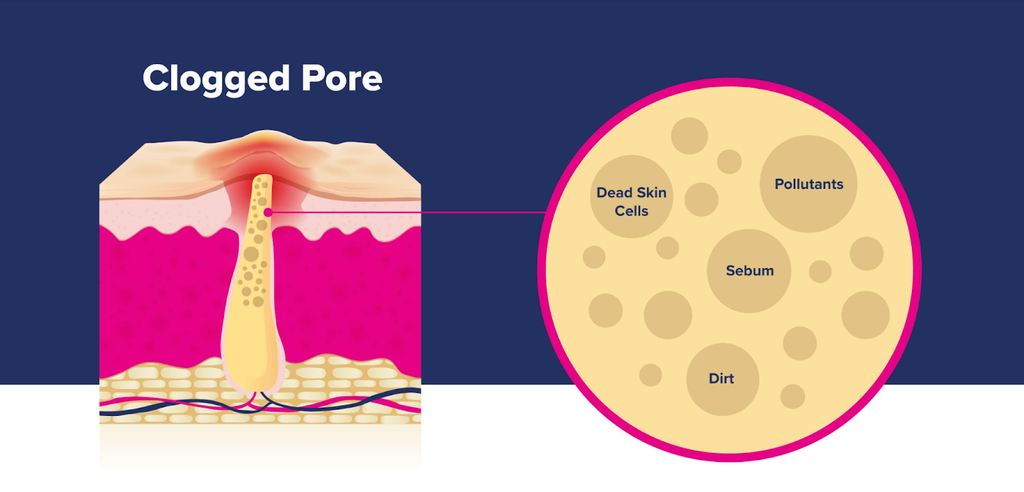 Clogged Pore