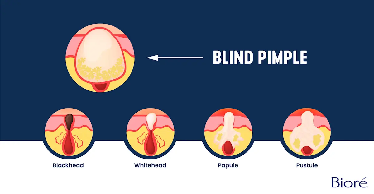 blind-pimple