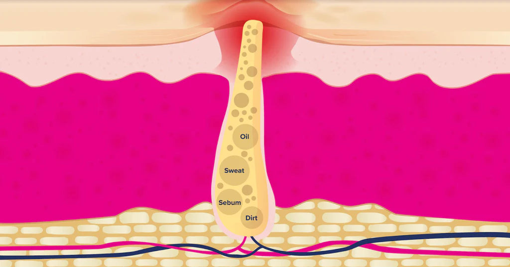 How to Remove Blackheads